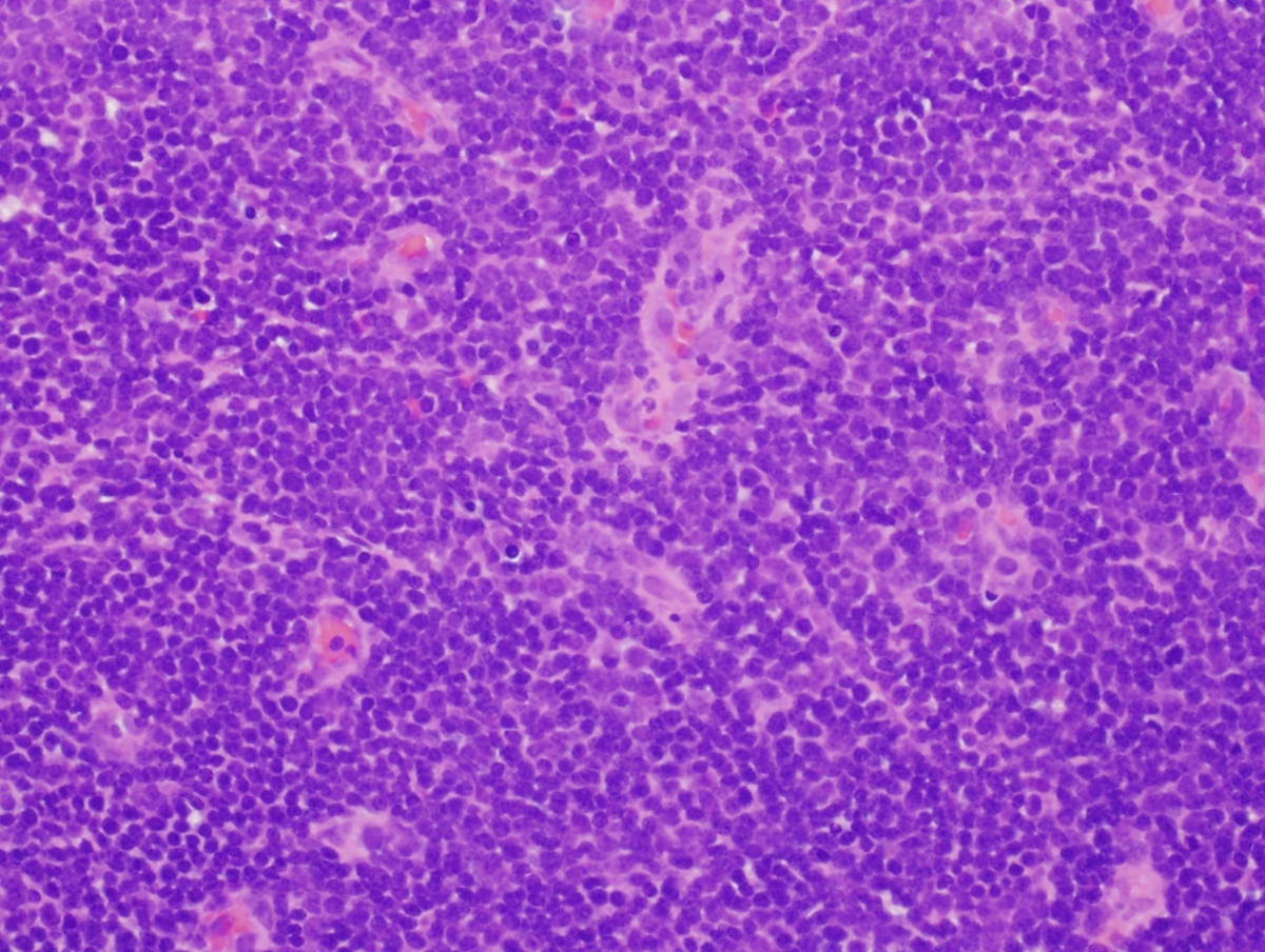 Lymph node biopsy (LN1) showing replacement by T lymphoblastic lymphoma (H&E, 20x).